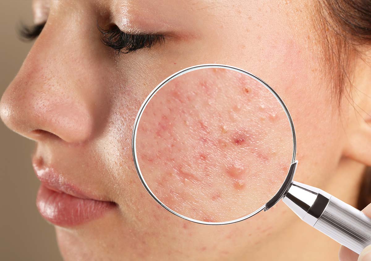 A girl with acne