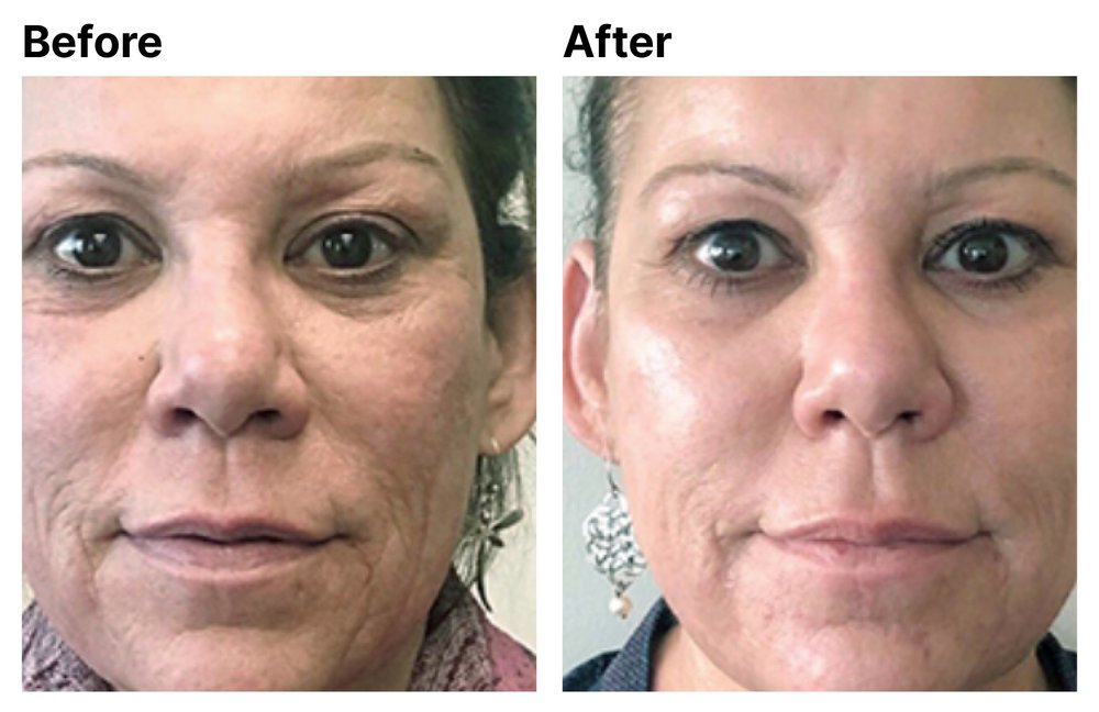 Before After Pt. #1 - Radiofrequency Microneedling