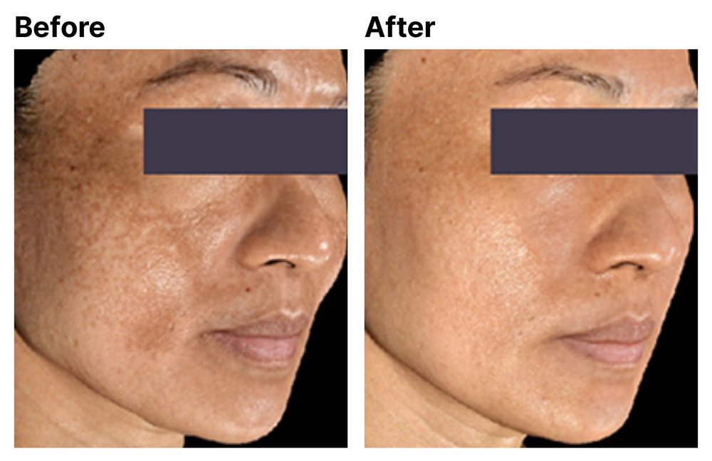 Before After Pt. #2 - Radiofrequency Microneedling