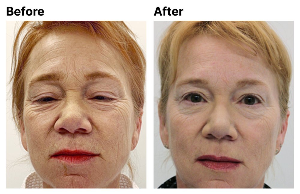Before After Pt. #3 - Radiofrequency Microneedling