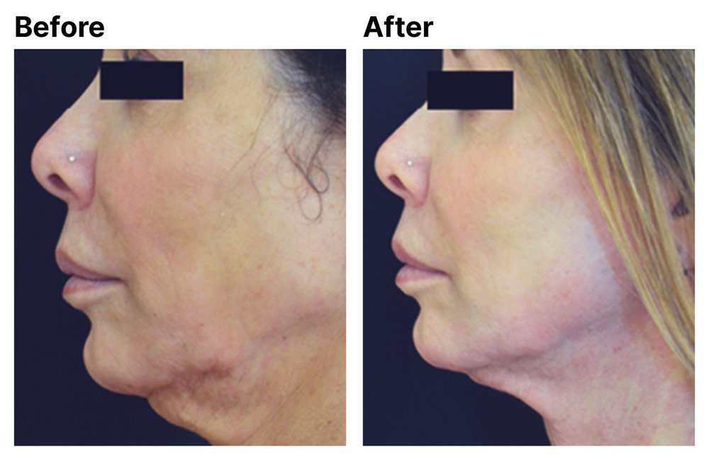 Before After Pt. #3 - Radiofrequency Microneedling