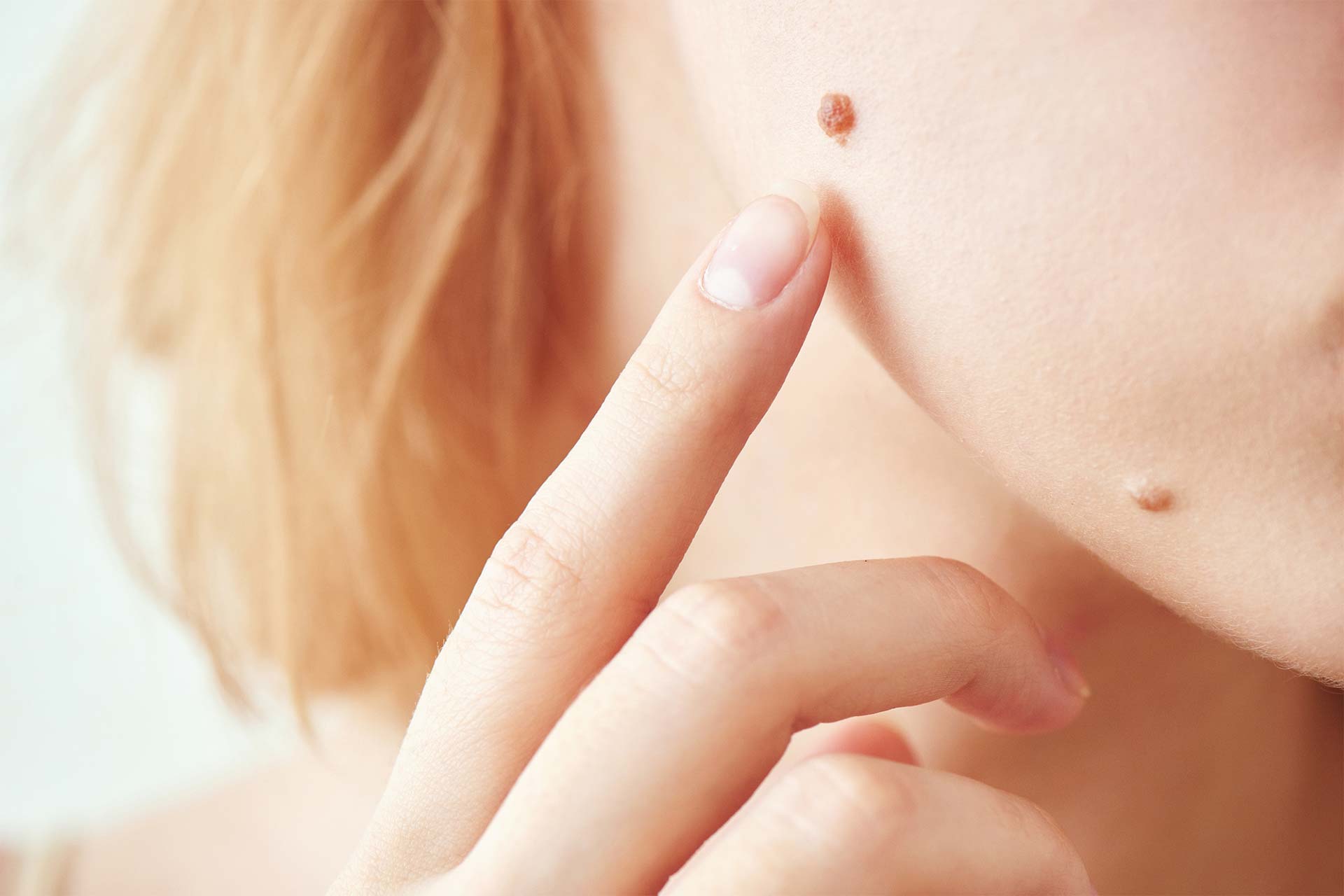 Mole on the young girl's face skin closeup